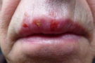 7 myths about herpes