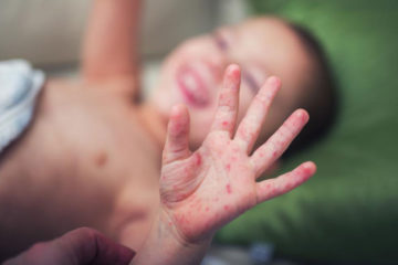 Causes and symptoms of Hand-foot-and-mouth disease