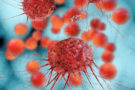 Everything you need to know about metastatic ovarian cancer