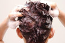 Five amazing home remedies for treating seborrheic dermatitis on scalp