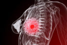 Five things you need to know about breast cancer
