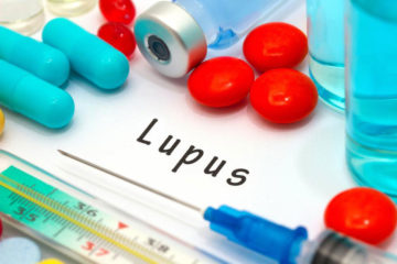 Lupus – An Overview