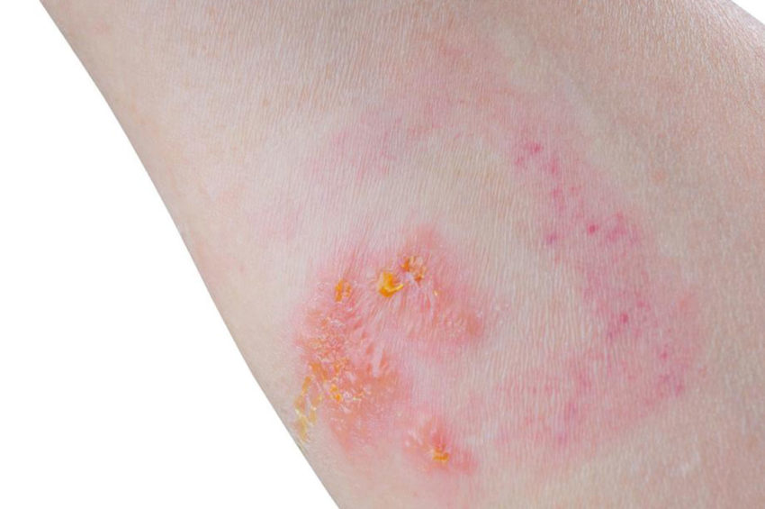 Skin Rash: Which condition is it?