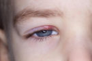 The 4 common causes of blepharitis