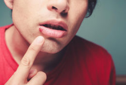Top 4 FAQs about cold sores