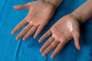 5 effective tips to manage hyperhidrosis